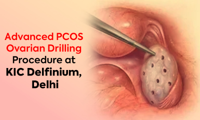 Advanced PCOS Ovarian Drilling Procedure at KIC Delfinium, Delhi
