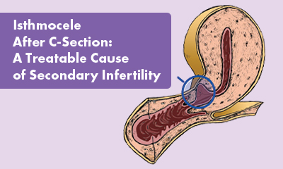 Isthmocele After C-Section: A Treatable Cause of Secondary Infertility